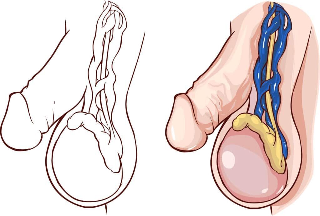 varicocele as a cause of pain in the testicles on arousal